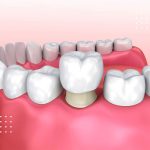 تفاوت روکش موقت و دائم