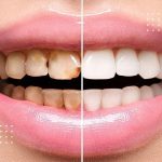 چگونه از پوسیدگی بین دندانی جلوگیری کنیم؟