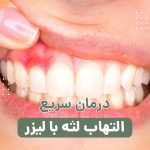 درمان سریع التهاب لثه با لیزر: روش‌ها، مزایا و خطرات