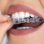 ارتودنسی سنتی یا الاینرها: مقایسه، مزایا و معایب