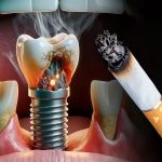 تأثیر سیگار و مصرف تنباکو بر درمان ایمپلنت