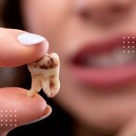 مراقبت پس از جراحی دندان عقل