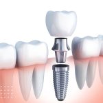 بررسی گزینه‌های ایمپلنت فوری پس از کشیدن دندان