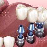 آیا ایمپلنت برای همه مناسب است؟