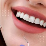 مراقبت‌های لازم بعد از لمینت دندان